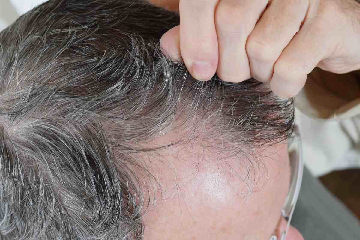 Uomo si tira un ciuffo di capelli